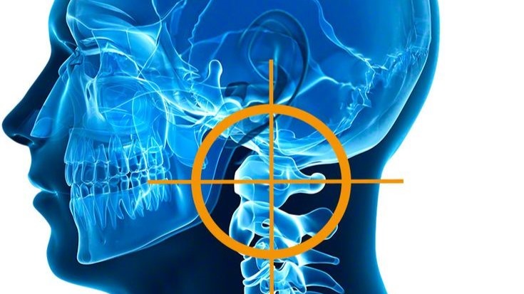 Ponticulus Posticus или старое название - аномалия Киммерле